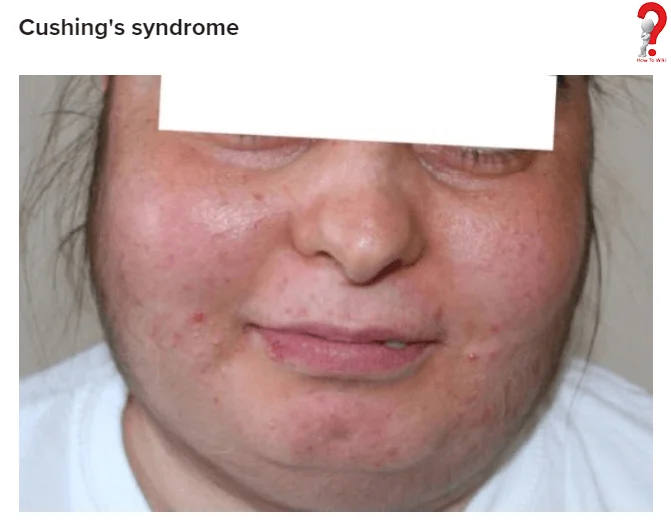 How To Reduce Swelling In Face - Causes & Treatment 4 Reduce Swelling On Face