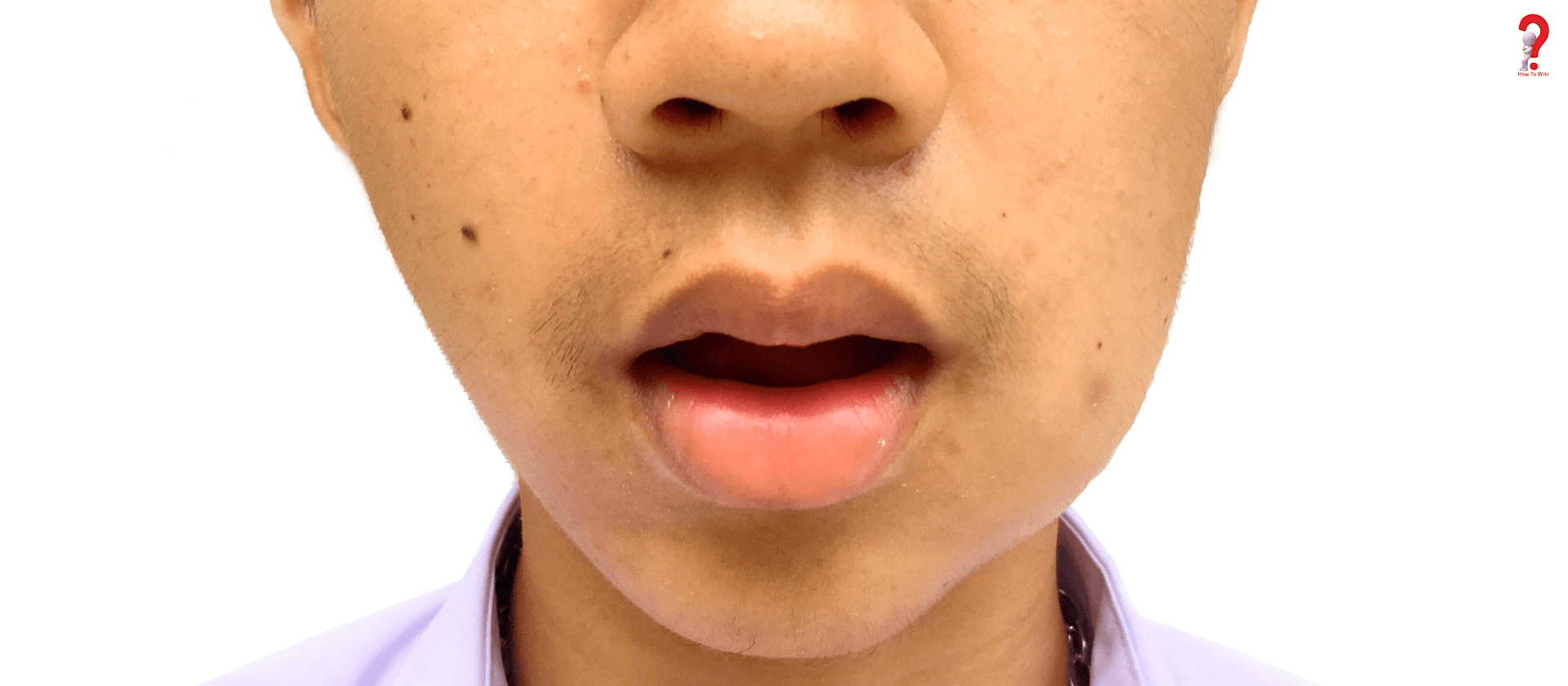 Left Side Of Face Swollen By Jaw 