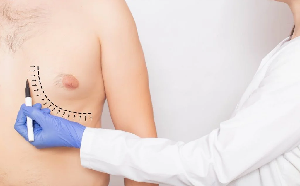Gynecomastia surgery